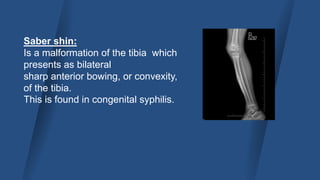 Musculoskeletal infection basics by capt alauddin.pptx