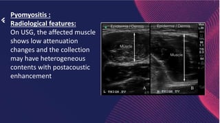 Pyomyositis Rad Musculoskeletal infection by capt alauddin.pptx