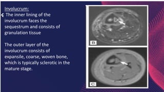 Musculoskeletal infection by capt alauddin.pptx