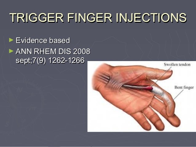 trigger finger steroid injection