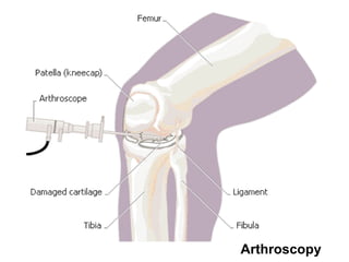 Arthroscopy
 