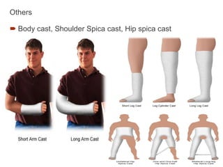 Others
 Body cast, Shoulder Spica cast, Hip spica cast
 