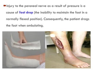 Injury to the peroneal nerve as a result of pressure is a
cause of foot drop (the inability to maintain the foot in a
normally flexed position). Consequently, the patient drags
the foot when ambulating.
 