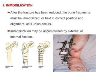2. IMMOBILIZATION
After the fracture has been reduced, the bone fragments
must be immobilized, or held in correct position and
alignment, until union occurs.
Immobilization may be accomplished by external or
internal fixation.
 