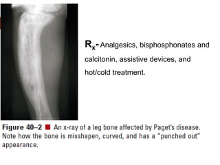 Rx- Analgesics, bisphosphonates and
calcitonin, assistive devices, and
hot/cold treatment.
 
