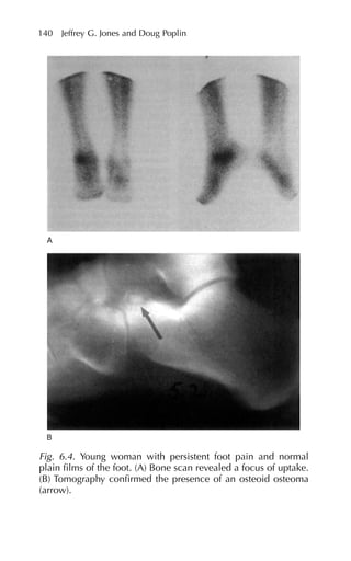 140 Jeffrey G. Jones and Doug Poplin
Fig. 6.4. Young woman with persistent foot pain and normal
plain films of the foot. (A) Bone scan revealed a focus of uptake.
(B) Tomography confirmed the presence of an osteoid osteoma
(arrow).
 