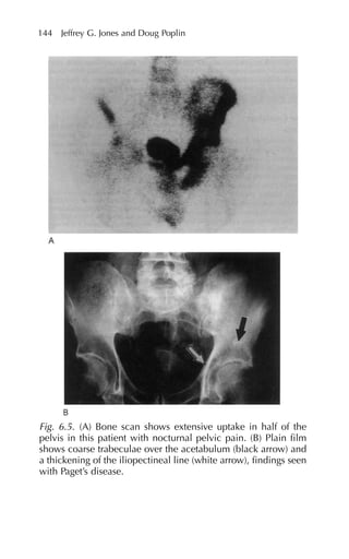 144 Jeffrey G. Jones and Doug Poplin
Fig. 6.5. (A) Bone scan shows extensive uptake in half of the
pelvis in this patient with nocturnal pelvic pain. (B) Plain film
shows coarse trabeculae over the acetabulum (black arrow) and
a thickening of the iliopectineal line (white arrow), findings seen
with Paget’s disease.
 