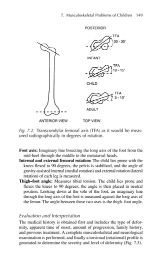 Foot axis: Imaginary line bisecting the long axis of the foot from the
mid-heel through the middle to the metatarsal heads.
Internal and external femoral rotation: The child lies prone with the
knees flexed to 90 degrees, the pelvis is stabilized, and the angle of
gravity-assisted internal (medial rotation) and external rotation (lateral
rotation) of each leg is measured.
Thigh–foot angle: Measures tibial torsion. The child lies prone and
flexes the knees to 90 degrees; the angle is then placed in neutral
position. Looking down at the sole of the foot, an imaginary line
through the long axis of the foot is measured against the long axis of
the femur. The angle between these two axes is the thigh–foot angle.
Evaluation and Interpretation
The medical history is obtained first and includes the type of defor-
mity, apparent time of onset, amount of progression, family history,
and previous treatment. A complete musculoskeletal and neurological
examination is performed, and finally a torsional (rotational) profile is
generated to determine the severity and level of deformity (Fig. 7.3).
7. Musculoskeletal Problems of Children 149
POSTERIOR
TFA
30 - 35⬚
10 - 15⬚
5 - 10⬚
CHILD
ADULT
TOP VIEW
ANTERIOR VIEW
INFANT
TFA
TFA
Fig. 7.2. Transcondylar femoral axis (TFA) as it would be meas-
ured radiographically in degrees of rotation.
 