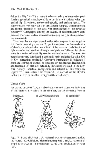 deformity (Fig. 7.4).10
It is thought to be secondary to intrauterine posi-
tion in a genetically predisposed fetus but is also associated with con-
genital hip dislocation, myelomeningocele, and arthrogryposis. The
major deformity of clubfoot is in the subtalar complex, with shortening
and medial deviation of the talus with displacement of the navicular
medially.11
Radiographs confirm the severity of deformity, allow com-
parisons over time, and are essential for judging the type of surgical cor-
rection needed.
Treatment by an experienced orthopedic surgeon is an acquired
skill that is becoming a lost art. Proper intervention involves reduction
of the displaced navicular on the head of the talus and mobilization of
tight capsules and tendons through manipulation followed by place-
ment in a series of carefully molded corrective casts. The need for
extensive surgery is reduced if casting is early and effective with 30%
to 50% correction obtained.12
Operative intervention is indicated if
complete correction cannot be obtained or maintained. Recognition
and treatment of clubfoot deformity should be initiated in the new-
born nursery; therefore, recognition and referral of this entity are
imperative. Parents should be reassured it is normal for the affected
foot and calf to be smaller throughout the child’s life.
Cavus Foot
Pes cavus, or cavus foot, is a fixed equinus and pronation deformity
of the forefoot in relation to the hindfoot, usually resulting from an
156 Mark D. Bracker et al.
A) NORMAL B) METATARSUS VARUS C) CLUB FOOT
25⬚
50⬚
5⬚
60⬚
30⬚
Fig. 7.4. Bone alignment. (A) Normal foot. (B) Metatarsus adduc-
tus (varus). (C) Clubfoot, demonstrating Kite’s angle. Note Kite’s
angle is increased in metatarsus varus and decreased in club
foot.
 