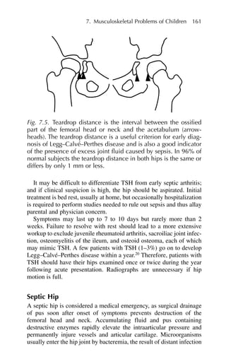 It may be difficult to differentiate TSH from early septic arthritis;
and if clinical suspicion is high, the hip should be aspirated. Initial
treatment is bed rest, usually at home, but occasionally hospitalization
is required to perform studies needed to rule out sepsis and thus allay
parental and physician concern.
Symptoms may last up to 7 to 10 days but rarely more than 2
weeks. Failure to resolve with rest should lead to a more extensive
workup to exclude juvenile rheumatoid arthritis, sacroiliac joint infec-
tion, osteomyelitis of the ileum, and osteoid osteoma, each of which
may mimic TSH. A few patients with TSH (1–3%) go on to develop
Legg–Calvé–Perthes disease within a year.20
Therefore, patients with
TSH should have their hips examined once or twice during the year
following acute presentation. Radiographs are unnecessary if hip
motion is full.
Septic Hip
A septic hip is considered a medical emergency, as surgical drainage
of pus soon after onset of symptoms prevents destruction of the
femoral head and neck. Accumulating fluid and pus containing
destructive enzymes rapidly elevate the intraarticular pressure and
permanently injure vessels and articular cartilage. Microorganisms
usually enter the hip joint by bacteremia, the result of distant infection
7. Musculoskeletal Problems of Children 161
Fig. 7.5. Teardrop distance is the interval between the ossified
part of the femoral head or neck and the acetabulum (arrow-
heads). The teardrop distance is a useful criterion for early diag-
nosis of Legg–Calvé–Perthes disease and is also a good indicator
of the presence of excess joint fluid caused by sepsis. In 96% of
normal subjects the teardrop distance in both hips is the same or
differs by only 1 mm or less.
 