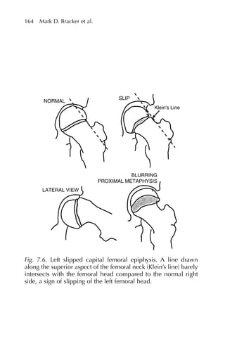 164 Mark D. Bracker et al.
NORMAL
SLIP
Klein's Line
BLURRING
PROXIMAL METAPHYSIS
LATERAL VIEW
Fig. 7.6. Left slipped capital femoral epiphysis. A line drawn
along the superior aspect of the femoral neck (Klein’s line) barely
intersects with the femoral head compared to the normal right
side, a sign of slipping of the left femoral head.
 
