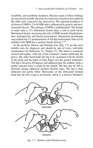 instability, and acetabular dysplasia. Because many of these findings
are not present at birth, the term developmental dysplasia has replaced
the older term congenital hip dislocation. The reported incidence of
all forms of DDH is 2 to 6/1000 and is influenced by genetic and envi-
ronmental factors. The etiology of DDH is multifactorial. The female
to male ratio is 5:1. Hormonal factors play a role in joint laxity.
Mechanical factors increasing the risk of DDH include oligohydram-
nios, primigravida, and breech presentation. Intrauterine positioning
may explain the 3:1 predominance of left hip involvement. One in five
children with DDH has a positive family history.27,28
In the newborn, Barlow and Ortolani tests (Fig. 7.7) are the most
reliable tests for diagnosis and should be part of every well-baby
examination (see Reference 51, Chapter 17). The infant is examined
relaxed and supine, with one of the examiner’s hands stabilizing the
pelvis. The other hand holds the hip to be examined with the thumb
in the groin and the index or long finger over the greater trochanter.
The hip is flexed to 90 degrees and adducted past the midline while a
gentle outward force is made by the thumb. The hip may be felt to
dislocate during adduction (positive Barlow sign). The hip is then
abducted and gently lifted. Relocation of the dislocated femoral
head may be felt (a pop is not heard), which is a positive Ortolani’s
7. Musculoskeletal Problems of Children 165
Dislocated
Reduced
Fig. 7.7. Barlow and Ortolani tests.
 