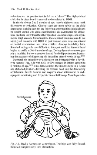 reduction test. A positive test is felt as a “clunk.” The high-pitched
click that is often heard is normal and unrelated to DDH.
In the child over 2 to 3 months of age, muscle tightness may mask
dislocation or reduction. Clinical signs are more subtle as the child
approaches walking age, but the following abnormalities should always
be sought during well-child examinations: an asymmetric hip abduc-
tion, one knee lower than the other (positive Galeazzi’s sign), and asym-
metric thigh creases. Unfortunately, these clinical examinations do not
identify all neonates with DDH, in part because some cases are missed
on initial examination and other children develop instability later.
Standard radiographs are difficult to interpret until the femoral head
begins to ossify at 3 to 6 months of age. During dynamic ultrasonogra-
phy a modified Barlow maneuver is used for the hip evaluation, increas-
ing the accuracy of diagnosing hip instability after 6 weeks of age.29,30
Neonatal hip instability or dislocation can be treated with a Pavlik-
type harness (Fig. 7.8) with 85% to 90% success in infants up to 6 to
8 months of age.31,32
This harness holds the infant’s hips in a flexed
and abducted position, directing the femoral head into the developing
acetabulum. Pavlik harness use requires close ultrasound or radi-
ographic monitoring and frequent clinical follow-up. Most hips stabi-
166 Mark D. Bracker et al.
Pavlik harness
Fig. 7.8. Pavlik harness on a newborn. The hips are fully flexed,
then fall out passively into abduction.
 