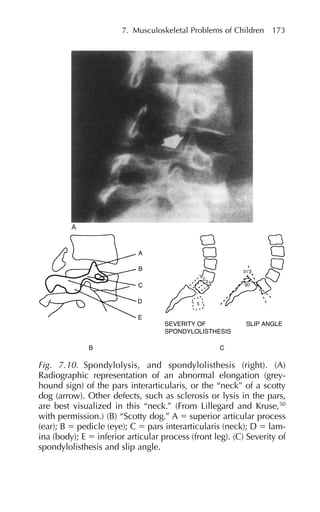 7. Musculoskeletal Problems of Children 173
B C
E
SEVERITY OF
SPONDYLOLISTHESIS
SLIP ANGLE
D
C
B
A
5
1
2
3
4 90⬚
31⬚
Fig. 7.10. Spondylolysis, and spondylolisthesis (right). (A)
Radiographic representation of an abnormal elongation (grey-
hound sign) of the pars interarticularis, or the “neck” of a scotty
dog (arrow). Other defects, such as sclerosis or lysis in the pars,
are best visualized in this “neck.” (From Lillegard and Kruse,50
with permission.) (B) “Scotty dog.” A ⫽ superior articular process
(ear); B ⫽ pedicle (eye); C ⫽ pars interarticularis (neck); D ⫽ lam-
ina (body); E ⫽ inferior articular process (front leg). (C) Severity of
spondylolisthesis and slip angle.
 