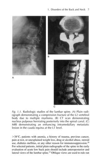 ⬎38°C, patients with anemia, a history of trauma, previous cancer,
pain at rest, or unexplained weight loss, drug or alcohol abuse, steroid
use, diabetes mellitus, or any other reason for immunosuppression.20
For selected patients, initial plain radiographs of the spine in the early
evaluation of acute low back pain should include anteroposterior and
lateral views of the lumbar spine.15
Oblique views are used to rule out
1. Disorders of the Back and Neck 7
Fig. 1.1. Radiologic studies of the lumbar spine. (A) Plain radi-
ograph demonstrating a compression fracture of the L2 vertebral
body due to multiple myeloma. (B) CT scan demonstrating
nucleus pulposus herniating posteriorly into the spinal canal. (C)
MRI demonstrating an enhancing intramedullary metastatic
lesion in the cauda equina at the L1 level.
 