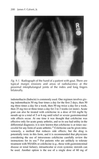 indomethacin (Indocin) is commonly used. One regimen involves giv-
ing indomethacin 50 mg four times a day for the first 2 days, then 50
mg three times a day for a week, then 50 mg twice a day for a week,
then 25 mg two or three times a day for 2 to 3 weeks (or more). Acute
gout can also be treated with colchicine in a dose of 0.6 mg/hr by
mouth up to a total of 5 or 6 mg until relief or severe gastrointestinal
side effects occur. At one time it was thought that colchicine was
effective only for acute gouty arthritis, and so its use had utility in the
differential diagnosis; it is now known that colchicine is at times suc-
cessful for any form of acute arthritis.15
Colchicine can be given intra-
venously, a method that reduces side effects; but the drug is
potentially toxic in this form, and it is recommended that physicians
considering the use of intravenous colchicine carefully review the
instructions for its use.16
For patients who are unlikely to tolerate
treatment with NSAIDs or colchicine (e.g., those with gastrointestinal
disease or renal failure), intraarticular or even systemic steroids can
be used. Another option is the use of a single dose of 60 mg of
200 James F. Calvert, Jr.
Fig. 9.1. Radiograph of the hand of a patient with gout. There are
typical margin erosions and areas of radiolucency at the
proximal interphalangeal joints of the index and long fingers
bilaterally.
 