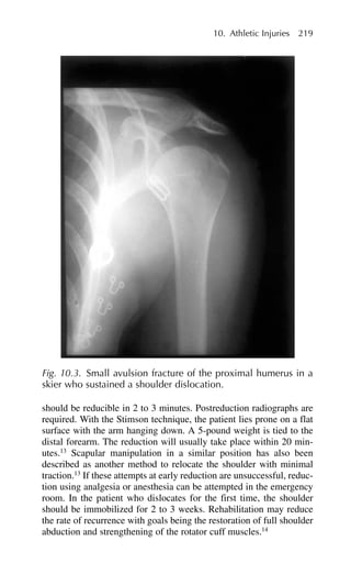 should be reducible in 2 to 3 minutes. Postreduction radiographs are
required. With the Stimson technique, the patient lies prone on a flat
surface with the arm hanging down. A 5-pound weight is tied to the
distal forearm. The reduction will usually take place within 20 min-
utes.13
Scapular manipulation in a similar position has also been
described as another method to relocate the shoulder with minimal
traction.13
If these attempts at early reduction are unsuccessful, reduc-
tion using analgesia or anesthesia can be attempted in the emergency
room. In the patient who dislocates for the first time, the shoulder
should be immobilized for 2 to 3 weeks. Rehabilitation may reduce
the rate of recurrence with goals being the restoration of full shoulder
abduction and strengthening of the rotator cuff muscles.14
10. Athletic Injuries 219
Fig. 10.3. Small avulsion fracture of the proximal humerus in a
skier who sustained a shoulder dislocation.
 