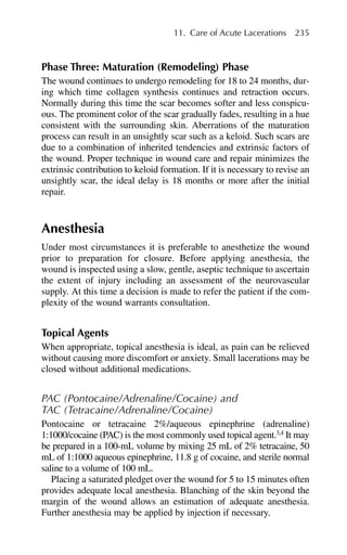 11. Care of Acute Lacerations 235
Phase Three: Maturation (Remodeling) Phase
The wound continues to undergo remodeling for 18 to 24 months, dur-
ing which time collagen synthesis continues and retraction occurs.
Normally during this time the scar becomes softer and less conspicu-
ous. The prominent color of the scar gradually fades, resulting in a hue
consistent with the surrounding skin. Aberrations of the maturation
process can result in an unsightly scar such as a keloid. Such scars are
due to a combination of inherited tendencies and extrinsic factors of
the wound. Proper technique in wound care and repair minimizes the
extrinsic contribution to keloid formation. If it is necessary to revise an
unsightly scar, the ideal delay is 18 months or more after the initial
repair.
Anesthesia
Under most circumstances it is preferable to anesthetize the wound
prior to preparation for closure. Before applying anesthesia, the
wound is inspected using a slow, gentle, aseptic technique to ascertain
the extent of injury including an assessment of the neurovascular
supply. At this time a decision is made to refer the patient if the com-
plexity of the wound warrants consultation.
Topical Agents
When appropriate, topical anesthesia is ideal, as pain can be relieved
without causing more discomfort or anxiety. Small lacerations may be
closed without additional medications.
PAC (Pontocaine/Adrenaline/Cocaine) and
TAC (Tetracaine/Adrenaline/Cocaine)
Pontocaine or tetracaine 2%/aqueous epinephrine (adrenaline)
1:1000/cocaine (PAC) is the most commonly used topical agent.3,4
It may
be prepared in a 100-mL volume by mixing 25 mL of 2% tetracaine, 50
mL of 1:1000 aqueous epinephrine, 11.8 g of cocaine, and sterile normal
saline to a volume of 100 mL.
Placing a saturated pledget over the wound for 5 to 15 minutes often
provides adequate local anesthesia. Blanching of the skin beyond the
margin of the wound allows an estimation of adequate anesthesia.
Further anesthesia may be applied by injection if necessary.
 