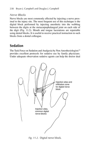 Nerve Blocks
Nerve blocks are most commonly effected by injecting a nerve prox-
imal to the injury site. The most frequent use of this technique is the
digital block performed by injecting anesthetic into the webbing
between the digits at the metacarpophalangeal joint on each side of
the digit (Fig. 11.2). Mouth and tongue lacerations are repairable
using dental blocks. It is useful to receive practical instruction in such
blocks from a dental colleague.
Sedation
The Task Force on Sedation and Analgesia by Non Anesthesiologists12
provides excellent protocols for sedative use by family physicians.
Under adequate observation sedative agents can help the doctor deal
238 Bryan J. Campbell and Douglas J. Campbell
Injection sites and
infiltration zone
for digital nerve
block
Injection sites,
common digital
nerve blocks
Fig. 11.2. Digital nerve block.
 