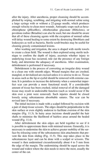 after the injury. After anesthesia, proper cleansing should be accom-
plished by wiping, scrubbing, and irrigating with normal saline using
a large syringe with or without a 22-gauge needle, which produces
enough velocity to clean most wounds. Antiseptic soaps such as hexa-
chlorophene (pHisoHex), chlorhexidine gluconate (Hibiclens), or
povidone-iodine (Betadine) can also be used, but one should be aware
that all of these cleansing agents with the exception of normal saline
will delay wound healing to some extent by destroying fibroblasts and
leukocytes as well as bacteria. Sterile scrub brushes may be useful for
cleaning grossly contaminated lesions.
After washing and irrigation, the area is draped with sterile towels
to create a clean field. The wound is then explored using sterile tech-
nique to confirm the depth of injury, ascertain whether injury to
underlying tissue has occurred, rule out the presence of any foreign
body, and determine the adequacy of anesthesia. After examination,
debridement is performed if necessary.
Debridement is the process of converting an irregular dirty wound
to a clean one with smooth edges. Wound margins that are crushed,
mangled, or devitalized are excised unless it is unwise to do so. Tissue
in areas such as the lip or eyelid should be removed with extreme cau-
tion. It is pointless to increase the deformity when a somewhat imper-
fect scar can provide a more functional result. If a considerable
amount of tissue has been crushed, initial removal of all the damaged
tissue may result in undesirable function (such as would occur if the
skin over a joint were removed). Such injuries should be closed
loosely using subcutaneous absorbable sutures. The scar can be
revised later if necessary.
The initial incision is made with a scalpel followed by excision with
a pair of sharp tissue scissors. The edges should be perpendicular to the
skin surface or even slightly undercut to facilitate eversion of the skin
margins (Fig. 11.3). In hairy areas incisions should parallel the hair
shafts to minimize the likelihood of hairless areas around the healed
wound (Fig. 11.4).
After debridement the skin edges are held together to see if it
is possible to approximate them with minimal tension. Generally, it is
necessary to undermine the skin to achieve greater mobility of the sur-
face by releasing some of the subcutaneous skin attachments that pre-
vent the skin from sliding (Fig. 11.5). This step takes place in the
subcutaneous layer and can be done with a scalpel or scissors. The
wound is then undermined circumferentially about 4 to 5 mm from
the edge of the margin. The undermining should be equal across the
wound and widest where the skin needs to move the most, usually the
center of the cut.
11. Care of Acute Lacerations 241
 