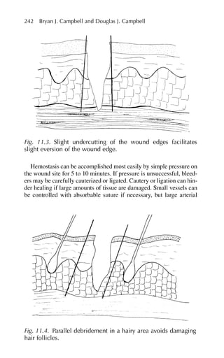 Hemostasis can be accomplished most easily by simple pressure on
the wound site for 5 to 10 minutes. If pressure is unsuccessful, bleed-
ers may be carefully cauterized or ligated. Cautery or ligation can hin-
der healing if large amounts of tissue are damaged. Small vessels can
be controlled with absorbable suture if necessary, but large arterial
242 Bryan J. Campbell and Douglas J. Campbell
Fig. 11.3. Slight undercutting of the wound edges facilitates
slight eversion of the wound edge.
Fig. 11.4. Parallel debridement in a hairy area avoids damaging
hair follicles.
 