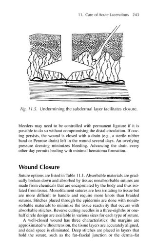 bleeders may need to be controlled with permanent ligature if it is
possible to do so without compromising the distal circulation. If ooz-
ing persists, the wound is closed with a drain (e.g., a sterile rubber
band or Penrose drain) left in the wound several days. An overlying
pressure dressing minimizes bleeding. Advancing the drain every
other day permits healing with minimal hematoma formation.
Wound Closure
Suture options are listed in Table 11.1. Absorbable materials are grad-
ually broken down and absorbed by tissue; nonabsorbable sutures are
made from chemicals that are encapsulated by the body and thus iso-
lated from tissue. Monofilament sutures are less irritating to tissue but
are more difficult to handle and require more knots than braided
sutures. Stitches placed through the epidermis are done with nonab-
sorbable materials to minimize the tissue reactivity that occurs with
absorbable stitches. Reverse cutting needles in a three-eighths or one-
half circle design are available in various sizes for each type of suture.
A well-closed wound has three characteristics: the margins are
approximated without tension, the tissue layers are accurately aligned,
and dead space is eliminated. Deep stitches are placed in layers that
hold the suture, such as the fat–fascial junction or the derma–fat
11. Care of Acute Lacerations 243
Fig. 11.5. Undermining the subdermal layer facilitates closure.
 