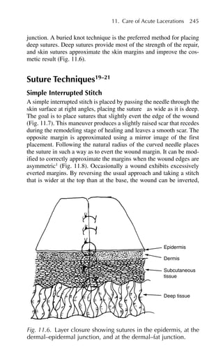 junction. A buried knot technique is the preferred method for placing
deep sutures. Deep sutures provide most of the strength of the repair,
and skin sutures approximate the skin margins and improve the cos-
metic result (Fig. 11.6).
Suture Techniques19–21
Simple Interrupted Stitch
A simple interrupted stitch is placed by passing the needle through the
skin surface at right angles, placing the suture as wide as it is deep.
The goal is to place sutures that slightly evert the edge of the wound
(Fig. 11.7). This maneuver produces a slightly raised scar that recedes
during the remodeling stage of healing and leaves a smooth scar. The
opposite margin is approximated using a mirror image of the first
placement. Following the natural radius of the curved needle places
the suture in such a way as to evert the wound margin. It can be mod-
ified to correctly approximate the margins when the wound edges are
asymmetric1
(Fig. 11.8). Occasionally a wound exhibits excessively
everted margins. By reversing the usual approach and taking a stitch
that is wider at the top than at the base, the wound can be inverted,
11. Care of Acute Lacerations 245
Deep tissue
Subcutaneous
tissue
Dermis
Epidermis
Fig. 11.6. Layer closure showing sutures in the epidermis, at the
dermal–epidermal junction, and at the dermal–fat junction.
 