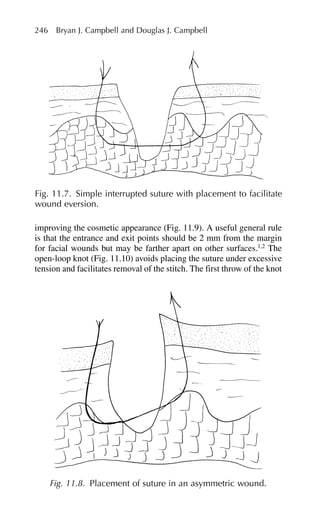 improving the cosmetic appearance (Fig. 11.9). A useful general rule
is that the entrance and exit points should be 2 mm from the margin
for facial wounds but may be farther apart on other surfaces.1,2
The
open-loop knot (Fig. 11.10) avoids placing the suture under excessive
tension and facilitates removal of the stitch. The first throw of the knot
246 Bryan J. Campbell and Douglas J. Campbell
Fig. 11.7. Simple interrupted suture with placement to facilitate
wound eversion.
Fig. 11.8. Placement of suture in an asymmetric wound.
 