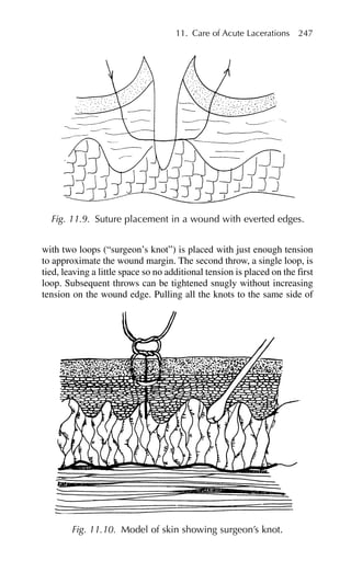 with two loops (“surgeon’s knot”) is placed with just enough tension
to approximate the wound margin. The second throw, a single loop, is
tied, leaving a little space so no additional tension is placed on the first
loop. Subsequent throws can be tightened snugly without increasing
tension on the wound edge. Pulling all the knots to the same side of
11. Care of Acute Lacerations 247
Fig. 11.9. Suture placement in a wound with everted edges.
Fig. 11.10. Model of skin showing surgeon’s knot.
 
