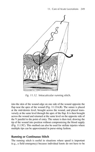 11. Care of Acute Lacerations 249
into the skin of the wound edge on one side of the wound opposite the
flap near the apex of the wound (Fig. 11.13A,B). The suture is placed
at the mid-dermis level, brought across the wound, and placed trans-
versely at the same level through the apex of the flap. It is then brought
across the wound and returned at the same level on the opposite side of
the V parallel to the point of entry. The suture is then tied, drawing the
tip of the wound into position without compromising the blood supply
(Fig. 11.13C). This method can also be used for stellate injuries where
multiple tips can be approximated in purse-string fashion.
Running or Continuous Stitch
The running stitch is useful in situations where speed is important
(e.g., a field emergency) because individual knots do not have to be
Fig. 11.12. Intracuticular running stitch.
 