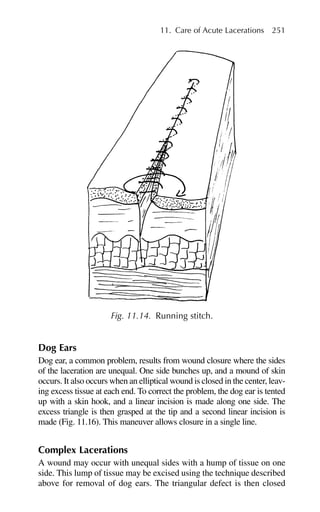 Dog Ears
Dog ear, a common problem, results from wound closure where the sides
of the laceration are unequal. One side bunches up, and a mound of skin
occurs. It also occurs when an elliptical wound is closed in the center, leav-
ing excess tissue at each end. To correct the problem, the dog ear is tented
up with a skin hook, and a linear incision is made along one side. The
excess triangle is then grasped at the tip and a second linear incision is
made (Fig. 11.16). This maneuver allows closure in a single line.
Complex Lacerations
A wound may occur with unequal sides with a hump of tissue on one
side. This lump of tissue may be excised using the technique described
above for removal of dog ears. The triangular defect is then closed
11. Care of Acute Lacerations 251
Fig. 11.14. Running stitch.
 