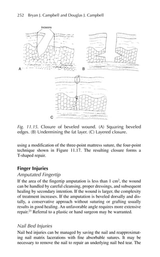 using a modification of the three-point mattress suture, the four-point
technique shown in Figure 11.17. The resulting closure forms a
T-shaped repair.
Finger Injuries
Amputated Fingertip
If the area of the fingertip amputation is less than 1 cm2
, the wound
can be handled by careful cleansing, proper dressings, and subsequent
healing by secondary intention. If the wound is larger, the complexity
of treatment increases. If the amputation is beveled dorsally and dis-
tally, a conservative approach without suturing or grafting usually
results in good healing. An unfavorable angle requires more extensive
repair.23
Referral to a plastic or hand surgeon may be warranted.
Nail Bed Injuries
Nail bed injuries can be managed by saving the nail and reapproximat-
ing nail matrix lacerations with fine absorbable sutures. It may be
necessary to remove the nail to repair an underlying nail bed tear. The
252 Bryan J. Campbell and Douglas J. Campbell
A B
C
Incisions
Fig. 11.15. Closure of beveled wound. (A) Squaring beveled
edges. (B) Undermining the fat layer. (C) Layered closure.
 