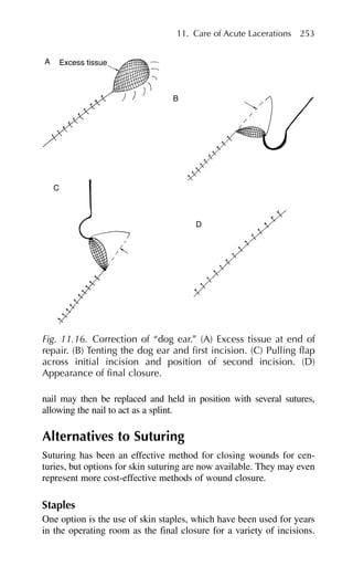 nail may then be replaced and held in position with several sutures,
allowing the nail to act as a splint.
Alternatives to Suturing
Suturing has been an effective method for closing wounds for cen-
turies, but options for skin suturing are now available. They may even
represent more cost-effective methods of wound closure.
Staples
One option is the use of skin staples, which have been used for years
in the operating room as the final closure for a variety of incisions.
11. Care of Acute Lacerations 253
A Excess tissue
C
B
D
Fig. 11.16. Correction of “dog ear.” (A) Excess tissue at end of
repair. (B) Tenting the dog ear and first incision. (C) Pulling flap
across initial incision and position of second incision. (D)
Appearance of final closure.
 
