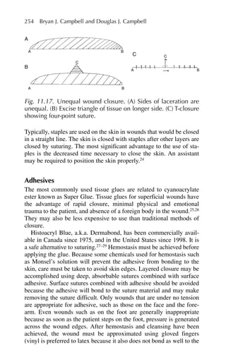 Typically, staples are used on the skin in wounds that would be closed
in a straight line. The skin is closed with staples after other layers are
closed by suturing. The most significant advantage to the use of sta-
ples is the decreased time necessary to close the skin. An assistant
may be required to position the skin properly.24
Adhesives
The most commonly used tissue glues are related to cyanoacrylate
ester known as Super Glue. Tissue glues for superficial wounds have
the advantage of rapid closure, minimal physical and emotional
trauma to the patient, and absence of a foreign body in the wound.25,26
They may also be less expensive to use than traditional methods of
closure.
Histoacryl Blue, a.k.a. Dermabond, has been commercially avail-
able in Canada since 1975, and in the United States since 1998. It is
a safe alternative to suturing.27–29
Hemostasis must be achieved before
applying the glue. Because some chemicals used for hemostasis such
as Monsel’s solution will prevent the adhesive from bonding to the
skin, care must be taken to avoid skin edges. Layered closure may be
accomplished using deep, absorbable sutures combined with surface
adhesive. Surface sutures combined with adhesive should be avoided
because the adhesive will bond to the suture material and may make
removing the suture difficult. Only wounds that are under no tension
are appropriate for adhesive, such as those on the face and the fore-
arm. Even wounds such as on the foot are generally inappropriate
because as soon as the patient steps on the foot, pressure is generated
across the wound edges. After hemostasis and cleansing have been
achieved, the wound must be approximated using gloved fingers
(vinyl is preferred to latex because it also does not bond as well to the
254 Bryan J. Campbell and Douglas J. Campbell
A
B
A
C
C
A
B
B
A B
C
Fig. 11.17. Unequal wound closure. (A) Sides of laceration are
unequal. (B) Excise triangle of tissue on longer side. (C) T-closure
showing four-point suture.
 