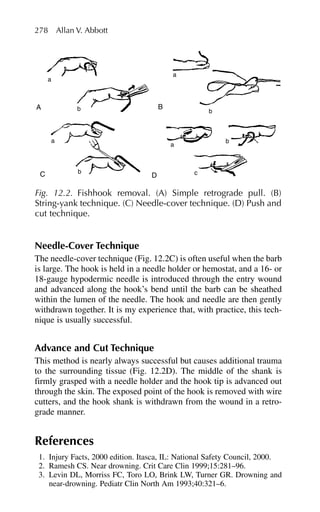 Needle-Cover Technique
The needle-cover technique (Fig. 12.2C) is often useful when the barb
is large. The hook is held in a needle holder or hemostat, and a 16- or
18-gauge hypodermic needle is introduced through the entry wound
and advanced along the hook’s bend until the barb can be sheathed
within the lumen of the needle. The hook and needle are then gently
withdrawn together. It is my experience that, with practice, this tech-
nique is usually successful.
Advance and Cut Technique
This method is nearly always successful but causes additional trauma
to the surrounding tissue (Fig. 12.2D). The middle of the shank is
firmly grasped with a needle holder and the hook tip is advanced out
through the skin. The exposed point of the hook is removed with wire
cutters, and the hook shank is withdrawn from the wound in a retro-
grade manner.
References
1. Injury Facts, 2000 edition. Itasca, IL: National Safety Council, 2000.
2. Ramesh CS. Near drowning. Crit Care Clin 1999;15:281–96.
3. Levin DL, Morriss FC, Toro LO, Brink LW, Turner GR. Drowning and
near-drowning. Pediatr Clin North Am 1993;40:321–6.
278 Allan V. Abbott
A B
D
a
b
a
C b
a
b
b
a
c
Fig. 12.2. Fishhook removal. (A) Simple retrograde pull. (B)
String-yank technique. (C) Needle-cover technique. (D) Push and
cut technique.
 