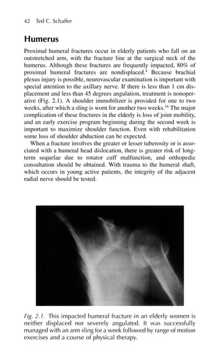 Humerus
Proximal humeral fractures occur in elderly patients who fall on an
outstretched arm, with the fracture line at the surgical neck of the
humerus. Although these fractures are frequently impacted, 80% of
proximal humeral fractures are nondisplaced.4
Because brachial
plexus injury is possible, neurovascular examination is important with
special attention to the axillary nerve. If there is less than 1 cm dis-
placement and less than 45 degrees angulation, treatment is nonoper-
ative (Fig. 2.1). A shoulder immobilizer is provided for one to two
weeks, after which a sling is worn for another two weeks.16
The major
complication of these fractures in the elderly is loss of joint mobility,
and an early exercise program beginning during the second week is
important to maximize shoulder function. Even with rehabilitation
some loss of shoulder abduction can be expected.
When a fracture involves the greater or lesser tuberosity or is asso-
ciated with a humeral head dislocation, there is greater risk of long-
term sequelae due to rotator cuff malfunction, and orthopedic
consultation should be obtained. With trauma to the humeral shaft,
which occurs in young active patients, the integrity of the adjacent
radial nerve should be tested.
42 Ted C. Schaffer
Fig. 2.1. This impacted humeral fracture in an elderly women is
neither displaced nor severely angulated. It was successfully
managed with an arm sling for a week followed by range of motion
exercises and a course of physical therapy.
 