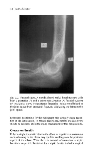 necessary; positioning for the radiograph may actually cause reduc-
tion of the subluxation. To prevent recurrence, parents and caregivers
should be educated about the injury mechanism for this benign entity.
Olecranon Bursitis
Either a single traumatic blow to the elbow or repetitive microtrauma
such as leaning on the elbow may result in swelling over the posterior
aspect of the elbow. When there is marked inflammation, a septic
bursitis is suspected. Treatment for a septic bursitis includes surgical
44 Ted C. Schaffer
Fig. 2.2. Fat pad signs. A nondisplaced radial head fracture with
both a posterior (P) and a prominent anterior (A) fat pad evident
on this lateral view. The posterior fat pad is indicative of blood in
the joint space from an occult fracture, displacing the fat from the
joint space.
 