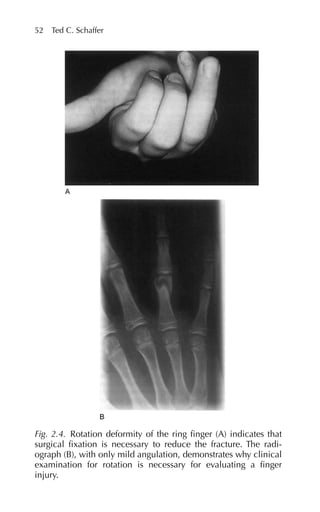 52 Ted C. Schaffer
Fig. 2.4. Rotation deformity of the ring finger (A) indicates that
surgical fixation is necessary to reduce the fracture. The radi-
ograph (B), with only mild angulation, demonstrates why clinical
examination for rotation is necessary for evaluating a finger
injury.
 