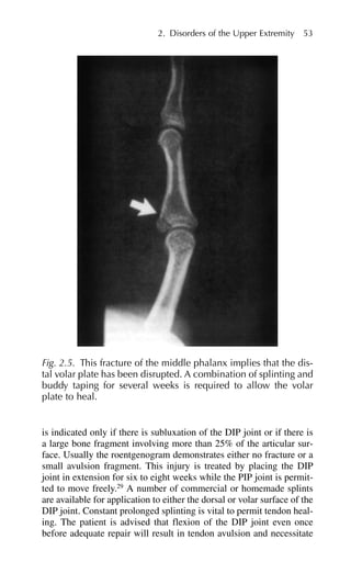 is indicated only if there is subluxation of the DIP joint or if there is
a large bone fragment involving more than 25% of the articular sur-
face. Usually the roentgenogram demonstrates either no fracture or a
small avulsion fragment. This injury is treated by placing the DIP
joint in extension for six to eight weeks while the PIP joint is permit-
ted to move freely.29
A number of commercial or homemade splints
are available for application to either the dorsal or volar surface of the
DIP joint. Constant prolonged splinting is vital to permit tendon heal-
ing. The patient is advised that flexion of the DIP joint even once
before adequate repair will result in tendon avulsion and necessitate
2. Disorders of the Upper Extremity 53
Fig. 2.5. This fracture of the middle phalanx implies that the dis-
tal volar plate has been disrupted. A combination of splinting and
buddy taping for several weeks is required to allow the volar
plate to heal.
 