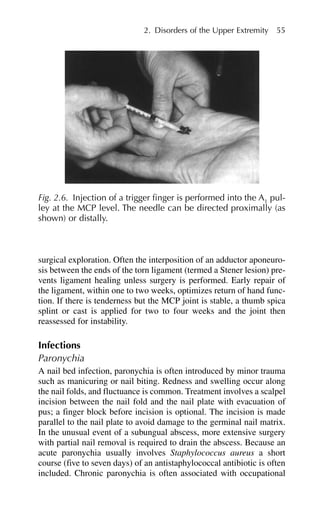2. Disorders of the Upper Extremity 55
surgical exploration. Often the interposition of an adductor aponeuro-
sis between the ends of the torn ligament (termed a Stener lesion) pre-
vents ligament healing unless surgery is performed. Early repair of
the ligament, within one to two weeks, optimizes return of hand func-
tion. If there is tenderness but the MCP joint is stable, a thumb spica
splint or cast is applied for two to four weeks and the joint then
reassessed for instability.
Infections
Paronychia
A nail bed infection, paronychia is often introduced by minor trauma
such as manicuring or nail biting. Redness and swelling occur along
the nail folds, and fluctuance is common. Treatment involves a scalpel
incision between the nail fold and the nail plate with evacuation of
pus; a finger block before incision is optional. The incision is made
parallel to the nail plate to avoid damage to the germinal nail matrix.
In the unusual event of a subungual abscess, more extensive surgery
with partial nail removal is required to drain the abscess. Because an
acute paronychia usually involves Staphylococcus aureus a short
course (five to seven days) of an antistaphylococcal antibiotic is often
included. Chronic paronychia is often associated with occupational
Fig. 2.6. Injection of a trigger finger is performed into the A1
pul-
ley at the MCP level. The needle can be directed proximally (as
shown) or distally.
 