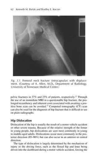 pelvic fractures in 37% and 23% of patients, respectively.12
Through
the use of an immediate MRI in a questionable hip fracture, the pro-
longed recumbency and inherent costs associated with awaiting a pos-
itive bone scan can be avoided.13
Computed tomography (CT) scan
can also be used for the diagnosis of hip fracture that is difficult to see
on plain radiographs.
Hip Dislocation
Dislocation of the hip is usually the result of a motor vehicle accident
or other severe trauma. Because of the relative strength of the femur
in young people, hip dislocations are seen most commonly in young
to middle-aged adults. Dislocations occur most commonly in the pos-
terior direction (85–90%) but can also occur in an anterior or central
direction.
The type of dislocation is largely determined by the mechanism of
injury or the driving force, such as the flexed hip and knee being
driven into the dashboard during a motor vehicle accident, forcing the
62 Kenneth M. Bielak and Bradley E. Kocian
Fig. 3.1. Femoral neck fracture (intracapsular) with displace-
ment. (Courtesy of A. Allen, M.D., Department of Radiology,
University of Tennessee Medical Center.)
 