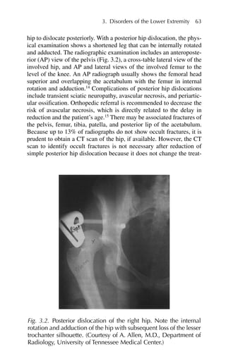 hip to dislocate posteriorly. With a posterior hip dislocation, the phys-
ical examination shows a shortened leg that can be internally rotated
and adducted. The radiographic examination includes an anteroposte-
rior (AP) view of the pelvis (Fig. 3.2), a cross-table lateral view of the
involved hip, and AP and lateral views of the involved femur to the
level of the knee. An AP radiograph usually shows the femoral head
superior and overlapping the acetabulum with the femur in internal
rotation and adduction.14
Complications of posterior hip dislocations
include transient sciatic neuropathy, avascular necrosis, and periartic-
ular ossification. Orthopedic referral is recommended to decrease the
risk of avascular necrosis, which is directly related to the delay in
reduction and the patient’s age.15
There may be associated fractures of
the pelvis, femur, tibia, patella, and posterior lip of the acetabulum.
Because up to 13% of radiographs do not show occult fractures, it is
prudent to obtain a CT scan of the hip, if available. However, the CT
scan to identify occult fractures is not necessary after reduction of
simple posterior hip dislocation because it does not change the treat-
3. Disorders of the Lower Extremity 63
Fig. 3.2. Posterior dislocation of the right hip. Note the internal
rotation and adduction of the hip with subsequent loss of the lesser
trochanter silhouette. (Courtesy of A. Allen, M.D., Department of
Radiology, University of Tennessee Medical Center.)
 