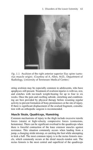 string avulsion may be especially common in adolescents, who have
apophyses still present. Treatment of avulsion injuries is with ice, rest,
and crutches with toe-touch weight-bearing for up to four to six
weeks. Once the pain and swelling subside, stretching and condition-
ing are best provided by physical therapy before resuming regular
activity to prevent formation of bony prominences at the site of injury.
If there is significant displacement of the avulsed fragment, consulta-
tion with an orthopedic surgeon is recommended.
Muscle Strain, Quadriceps, Hamstring
Common mechanisms of injury to the thigh include excessive tensile
forces (strain) or high-velocity compressive forces (contusions,
hematoma). There can be significant overload to the quadriceps when
there is forceful contraction of the knee extensor muscles against
resistance. This situation commonly occurs when landing from a
jump, a changing stride misstep, or catching the foot while attempting
to kick a ball. The most common injury is to the rectus femoris mus-
cle, which commonly occurs at the distal muscle–tendon unit. The
rectus femoris is the most central and superficial of the quadriceps
3. Disorders of the Lower Extremity 65
Fig. 3.3. Avulsion of the right anterior superior iliac spine (sarto-
rius muscle origin). (Courtesy of A. Allen, M.D., Department of
Radiology, University of Tennessee Medical Center.)
 