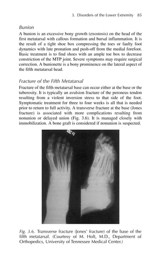 Bunion
A bunion is an excessive bony growth (exostosis) on the head of the
first metatarsal with callous formation and bursal inflammation. It is
the result of a tight shoe box compressing the toes or faulty foot
dynamics with late pronation and push-off from the medial forefoot.
Basic treatment is to find shoes with an ample toe box to decrease
constriction of the MTP joint. Severe symptoms may require surgical
correction. A bunionette is a bony prominence on the lateral aspect of
the fifth metatarsal head.
Fracture of the Fifth Metatarsal
Fracture of the fifth metatarsal base can occur either at the base or the
tuberosity. It is typically an avulsion fracture of the peroneus tendon
resulting from a violent inversion stress to that side of the foot.
Symptomatic treatment for three to four weeks is all that is needed
prior to return to full activity. A transverse fracture at the base (Jones
fracture) is associated with more complications resulting from
nonunion or delayed union (Fig. 3.6). It is managed closely with
immobilization. A bone graft is considered if nonunion is suspected.
3. Disorders of the Lower Extremity 85
Fig. 3.6. Transverse fracture (Jones’ fracture) of the base of the
fifth metatarsal. (Courtesy of M. Holt, M.D., Department of
Orthopedics, University of Tennessee Medical Center.)
 
