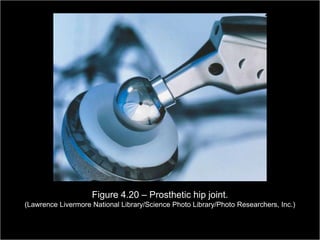 Figure 4.20 – Prosthetic hip joint.
(Lawrence Livermore National Library/Science Photo Library/Photo Researchers, Inc.)

                                                              Copyright ©2009 by Pearson Education, Inc.
 Medical Terminology: A Living Language, Fourth Edition           Upper Saddle River, New Jersey 07458
                                                                                                120
 Bonnie F. Fremgen and Suzanne S. Frucht                                              All rights reserved.
 