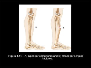 Figure 4.14 – A) Open (or compound) and B) closed (or simple)
                            fractures.
                                                         Copyright ©2009 by Pearson Education, Inc.
Medical Terminology: A Living Language, Fourth Edition       Upper Saddle River, New Jersey 07458
                                                                                            95
Bonnie F. Fremgen and Suzanne S. Frucht                                          All rights reserved.
 