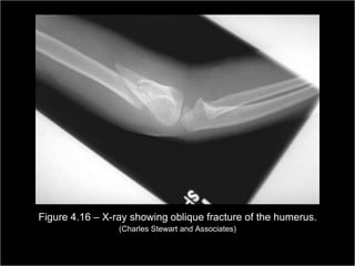 Figure 4.16 – X-ray showing oblique fracture of the humerus.
                                  (Charles Stewart and Associates)

                                                                     Copyright ©2009 by Pearson Education, Inc.
Medical Terminology: A Living Language, Fourth Edition                   Upper Saddle River, New Jersey 07458
                                                                                                        98
Bonnie F. Fremgen and Suzanne S. Frucht                                                      All rights reserved.
 
