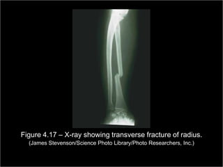 Figure 4.17 – X-ray showing transverse fracture of radius.
    (James Stevenson/Science Photo Library/Photo Researchers, Inc.)

                                                         Copyright ©2009 by Pearson Education, Inc.
Medical Terminology: A Living Language, Fourth Edition       Upper Saddle River, New Jersey 07458
                                                                                           100
Bonnie F. Fremgen and Suzanne S. Frucht                                          All rights reserved.
 
