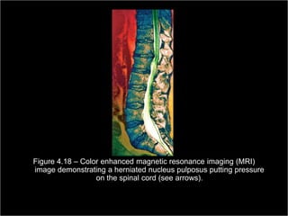 Figure 4.18 – Color enhanced magnetic resonance imaging (MRI)
  image demonstrating a herniated nucleus pulposus putting pressure
                    on the spinal cord (see arrows).

                                                         Copyright ©2009 by Pearson Education, Inc.
Medical Terminology: A Living Language, Fourth Edition       Upper Saddle River, New Jersey 07458
                                                                                           105
Bonnie F. Fremgen and Suzanne S. Frucht                                          All rights reserved.
 