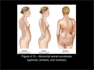 Figure 4.13 – Abnormal spinal curvatures:
                       kyphosis, lordosis, and scoliosis.
                                                         Copyright ©2009 by Pearson Education, Inc.
Medical Terminology: A Living Language, Fourth Edition       Upper Saddle River, New Jersey 07458
                                                                                           106
Bonnie F. Fremgen and Suzanne S. Frucht                                          All rights reserved.
 